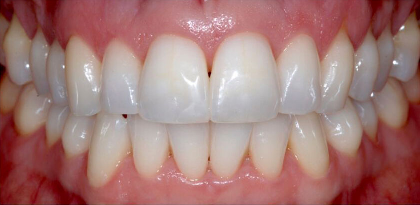 Teeth after ClearStep treatment