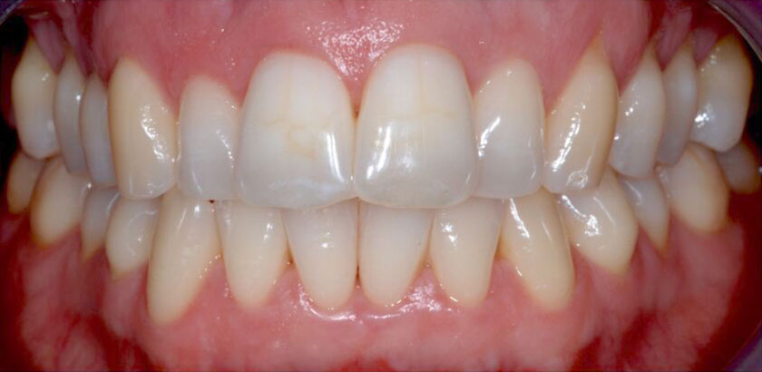 Teeth before ClearStep treatment