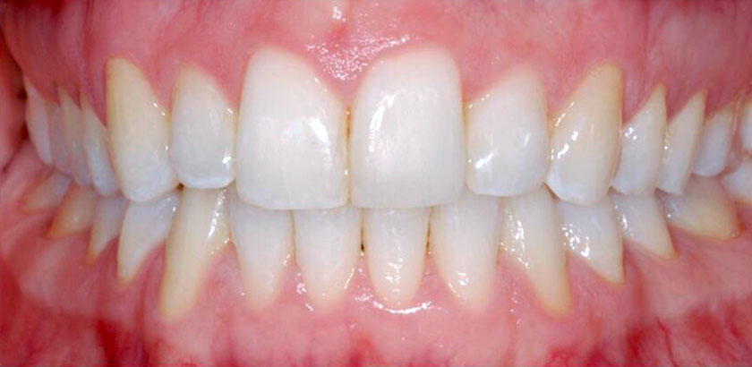 Teeth after LiteWire treatment
