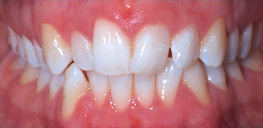 Teeth before LiteWire treatment